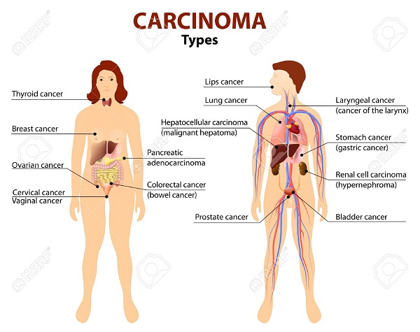 carcinoma loại ung thư phổ biến nhất